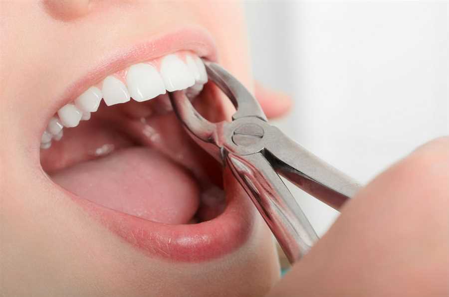 Wisdom Tooth Extractions in Mississauga