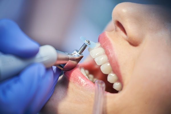 Deep Teeth Cleaning in Mississauga