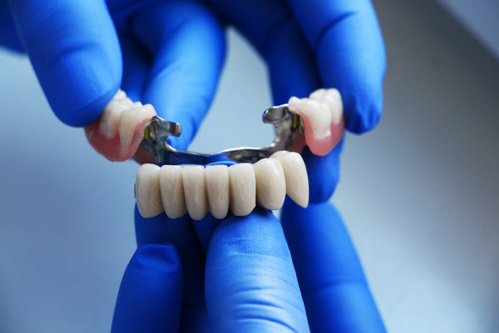 Dental Bridge in Mississauga