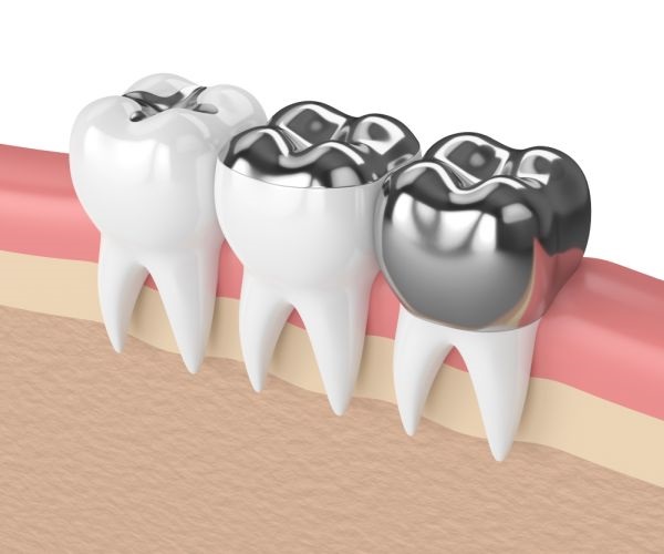Dental Crowns in Mississauga
