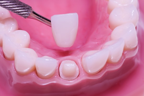 Dental Crowns in Mississauga
