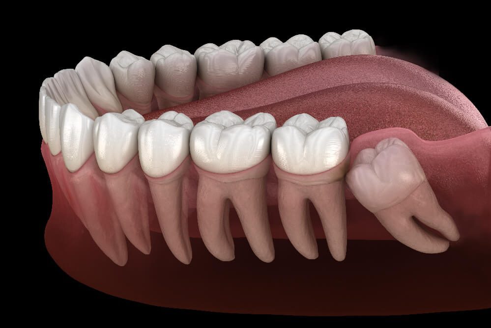 Wisdom Tooth Extractions in Mississauga