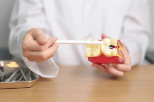 Dentist pointing to a decayed tooth on a dental model