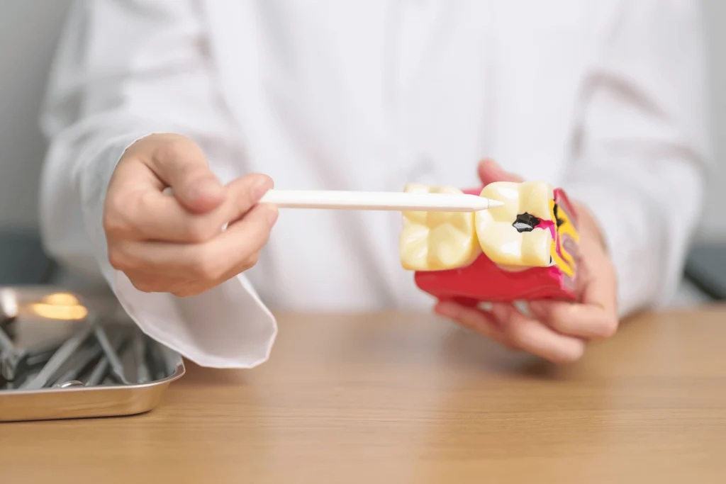 Dentist pointing to a decayed tooth on a dental model