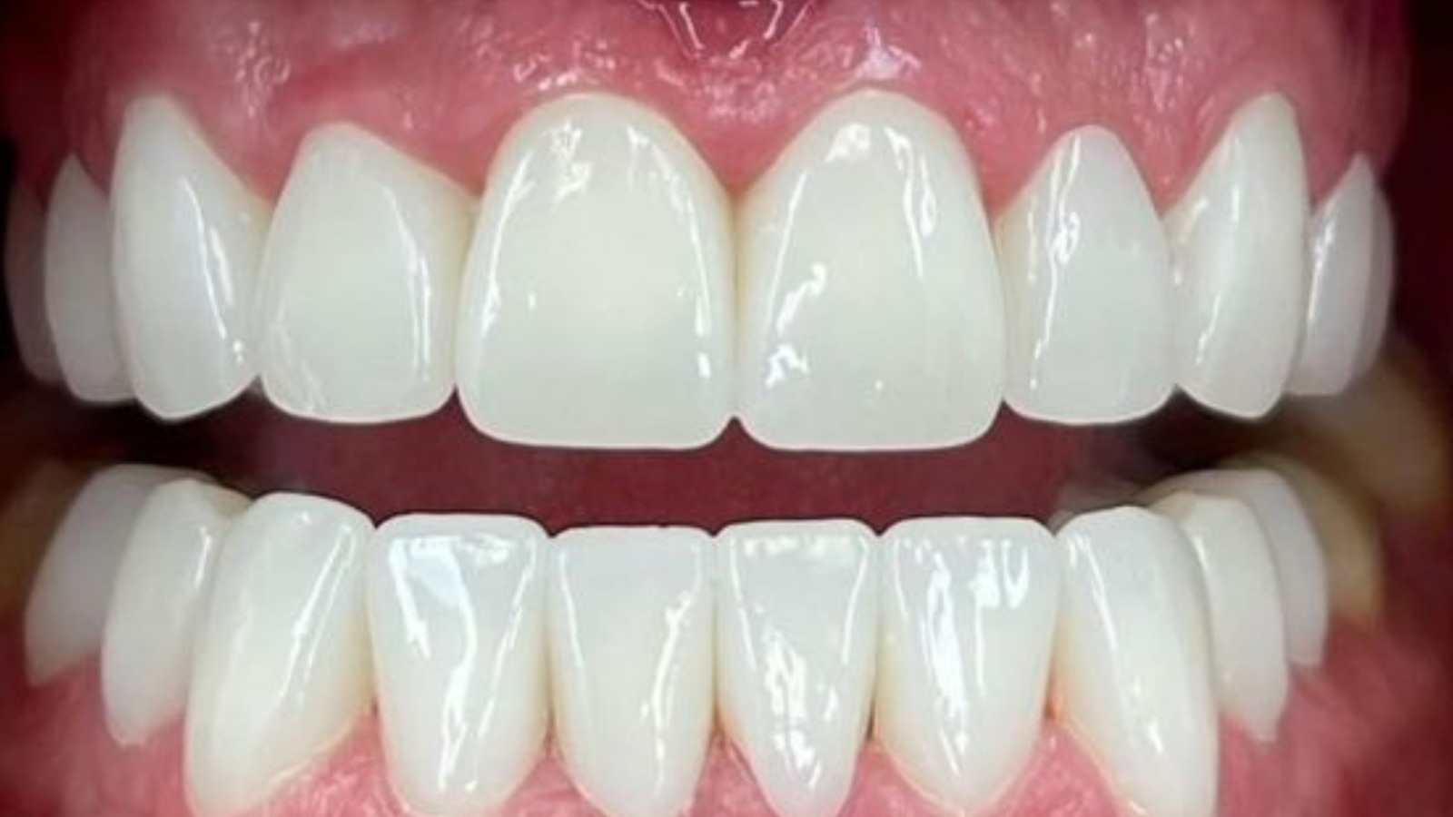 After smile makeover - Eglinton Oak Dental Mississauga