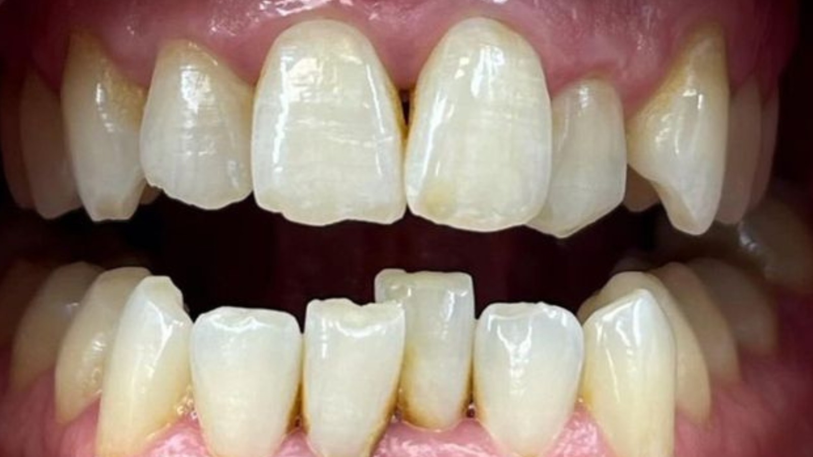 Before smile makeover - Eglinton Oak Dental Mississauga