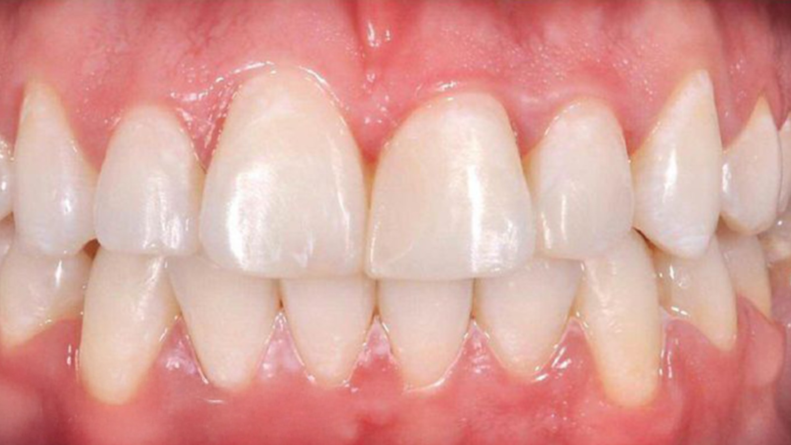 After smile makeover - Eglinton Oak Dental Mississauga