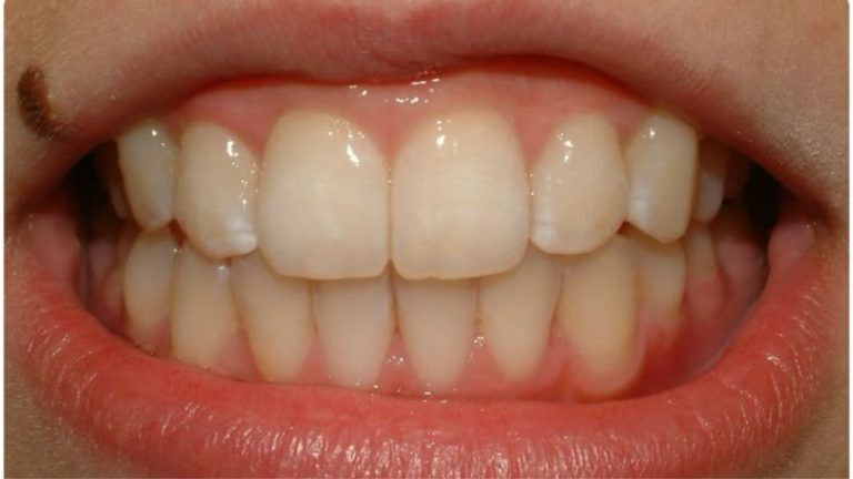 Invisalign Result