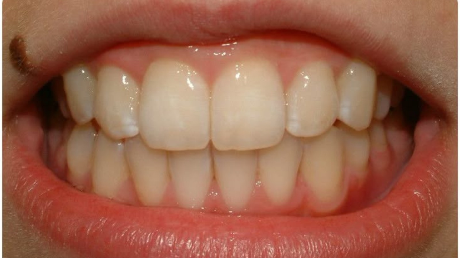 After smile makeover - Eglinton Oak Dental Mississauga