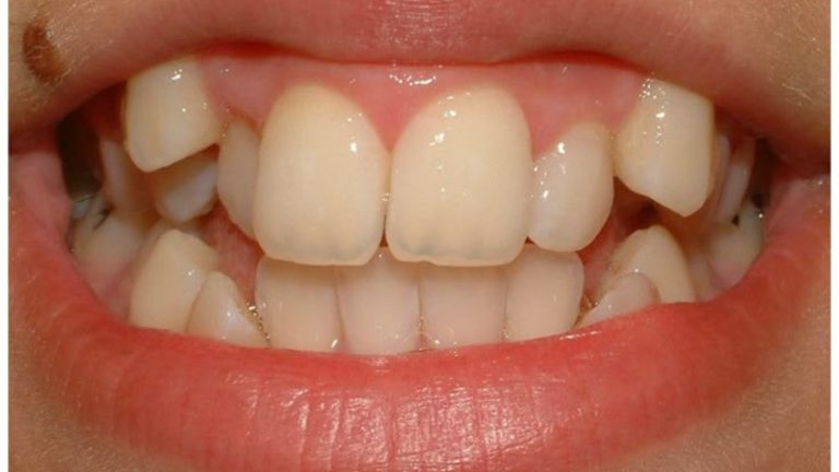 Invisalign Before