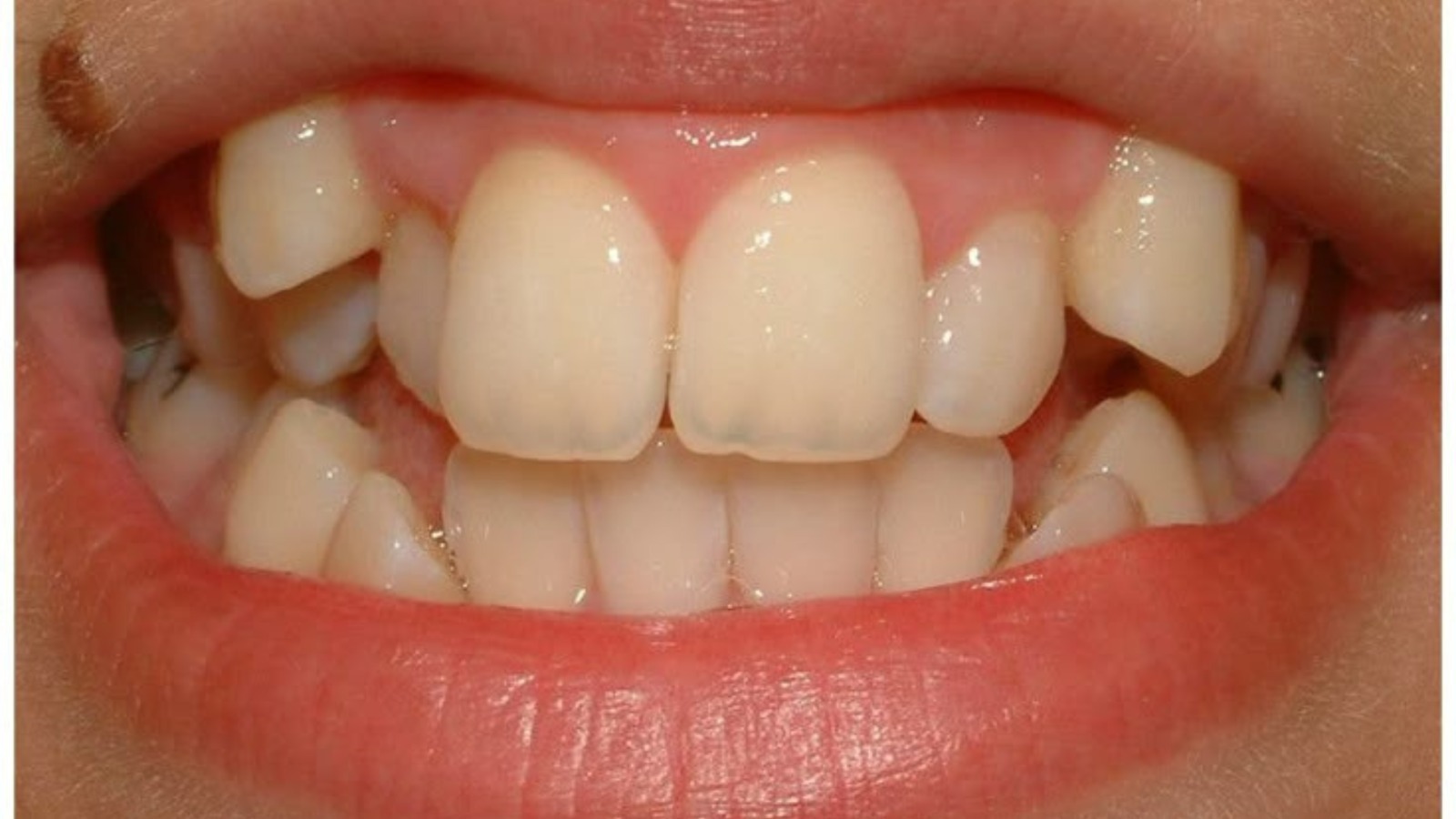Before smile makeover - Eglinton Oak Dental Mississauga