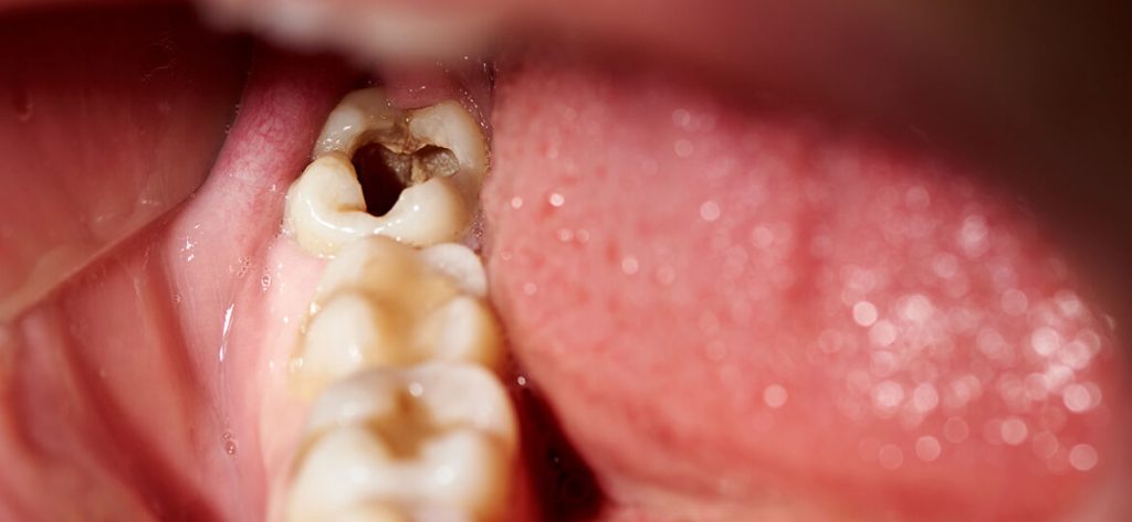 Fluortide Treatment in Mississauga