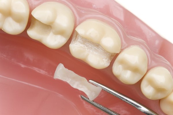 Dental Sealants in Mississauga