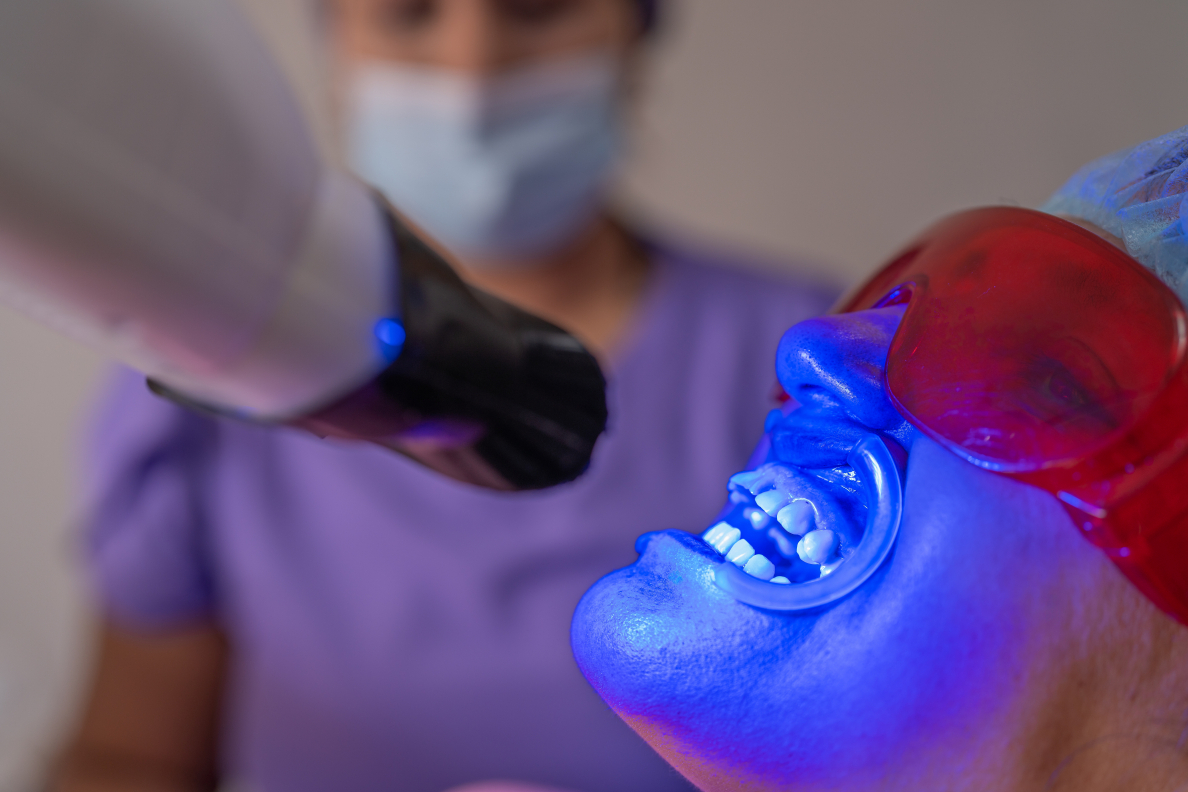Teeth Whitening in Mississauga