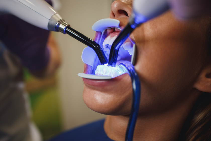 Teeth Whitening in Mississauga