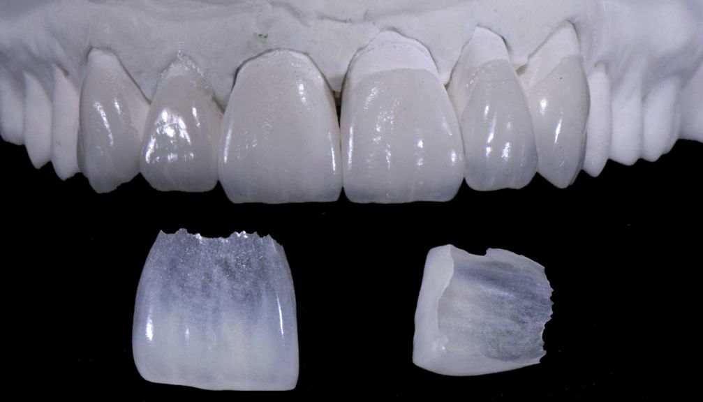 Dental Veneers in Mississauga