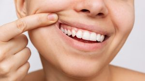 Dental Sealants in Mississauga
