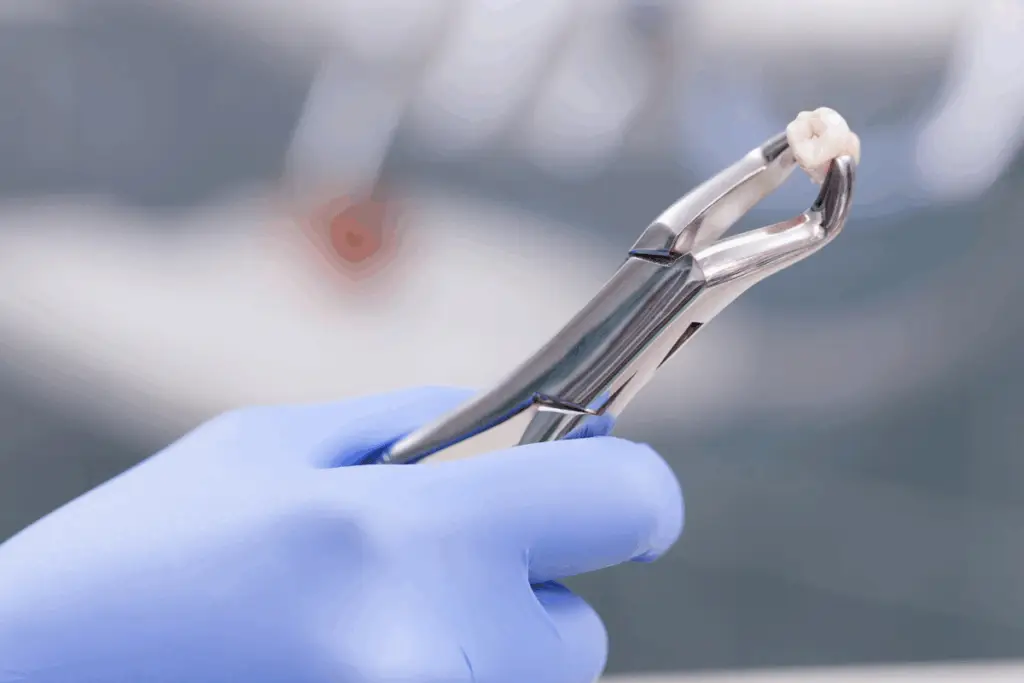 Tooth Extractions in Mississauga
