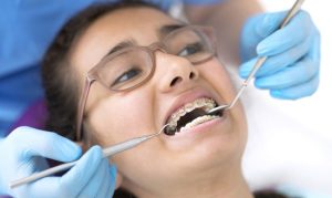 Tooth Extractions in Mississauga