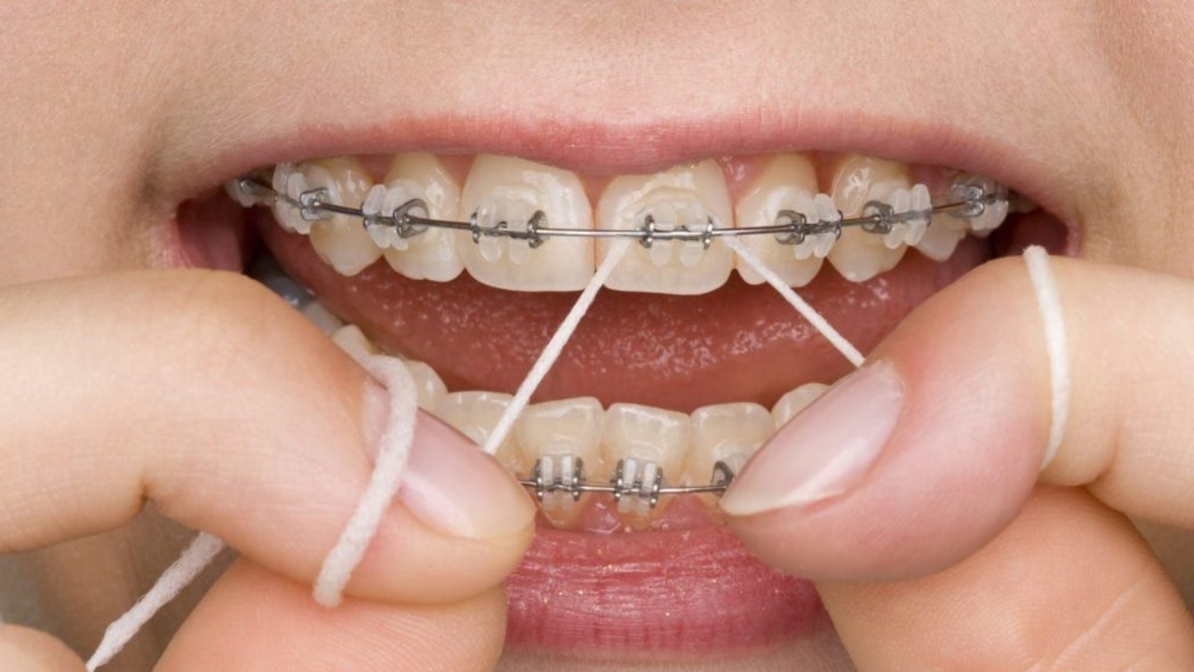 Braces in Mississauga - orthodontic treatment at Eglinton Oak Dental