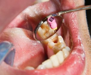 Endodontic Treatment – Eglinton Oak Dental, Mississauga