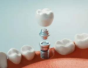 Dental implants in Mississauga