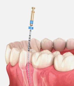 Img Root Canal Treatment – Eglinton Oak Dental, Mississauga