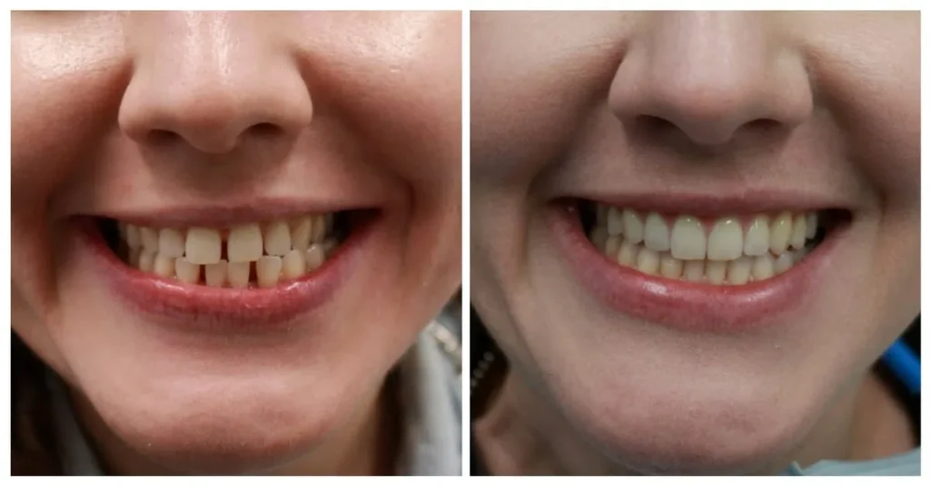 Invisalign cost in Mississauga - clear aligners