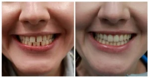 Invisalign Clear Aligners in Mississauga