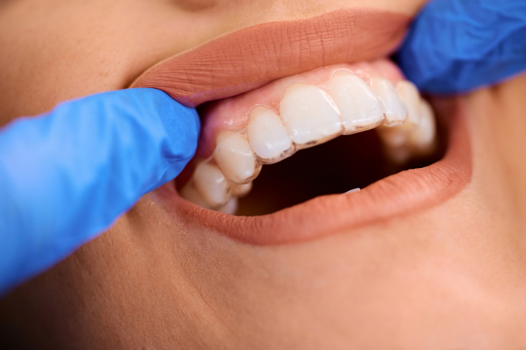 Dental professional fitting a clear aligner tray over a patient's teeth