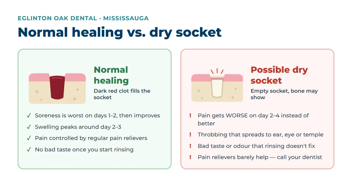 Diagram comparing a normal healing tooth socket with a blood clot and a dry socket with exposed bone